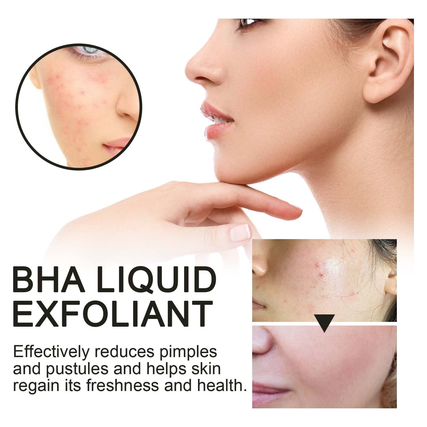 Hoygi BHA Liquid Exfoliant, Lightening Acne Seal Pore-Tightening And Moisturizing Skin Essence
