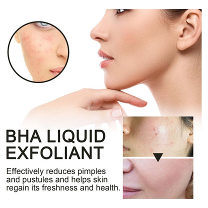 Hoygi BHA Liquid Exfoliant, Lightening Acne Seal Pore-Tightening And Moisturizing Skin Essence