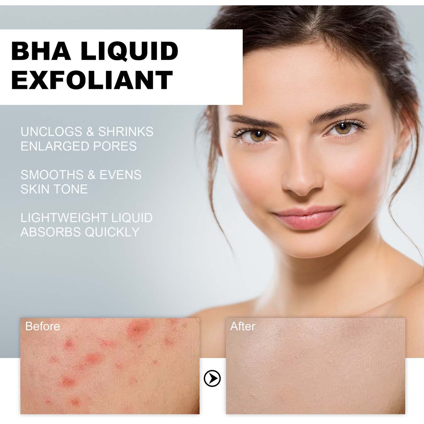 Hoygi BHA Liquid Exfoliant, Lightening Acne Seal Pore-Tightening And Moisturizing Skin Essence